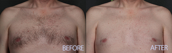 Chest hair Before and After