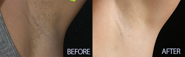Armpits Before and After